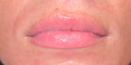 Facial Esthetics After 1